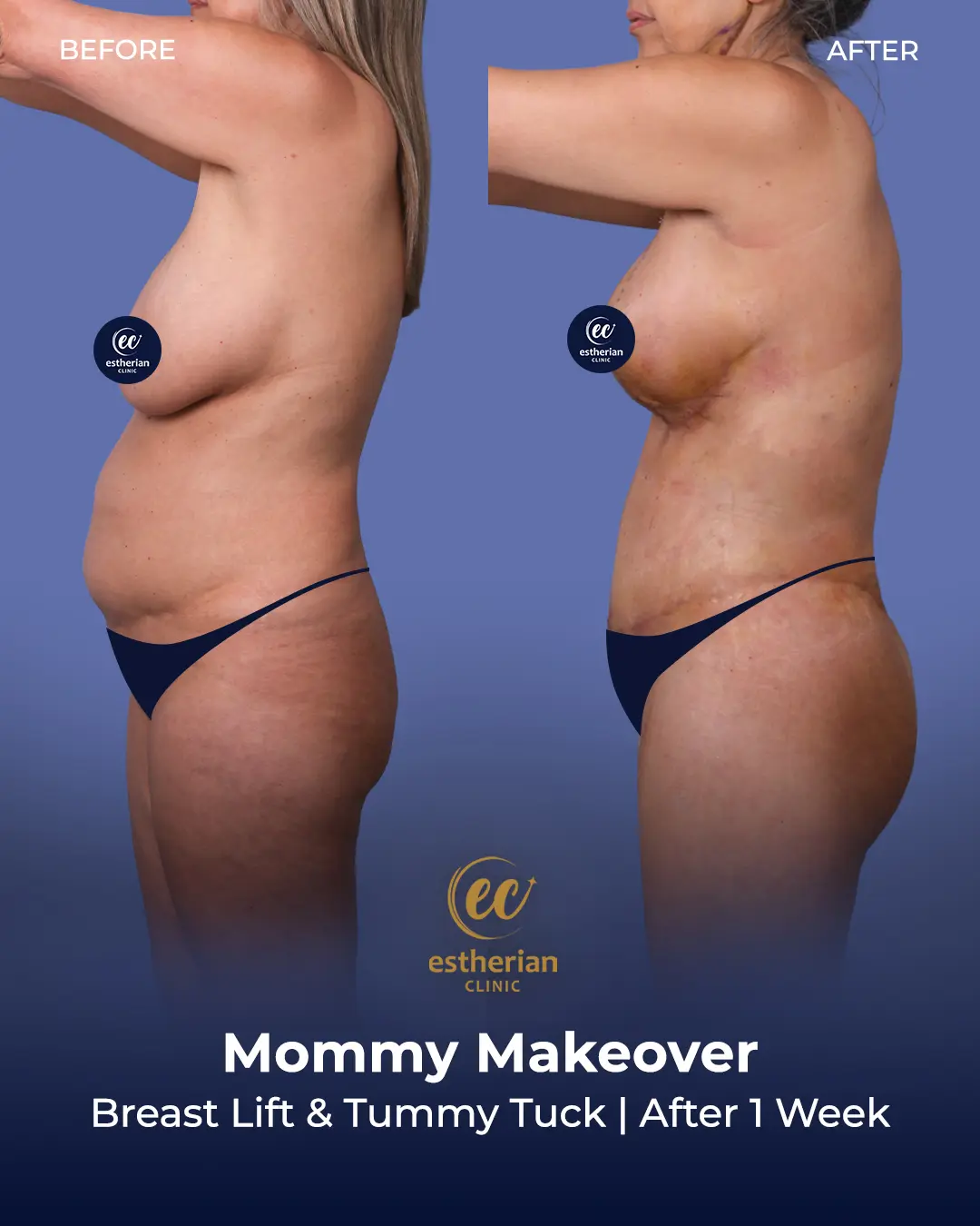 Body Contouring Surgery (before and after) by the Estherian Clinic