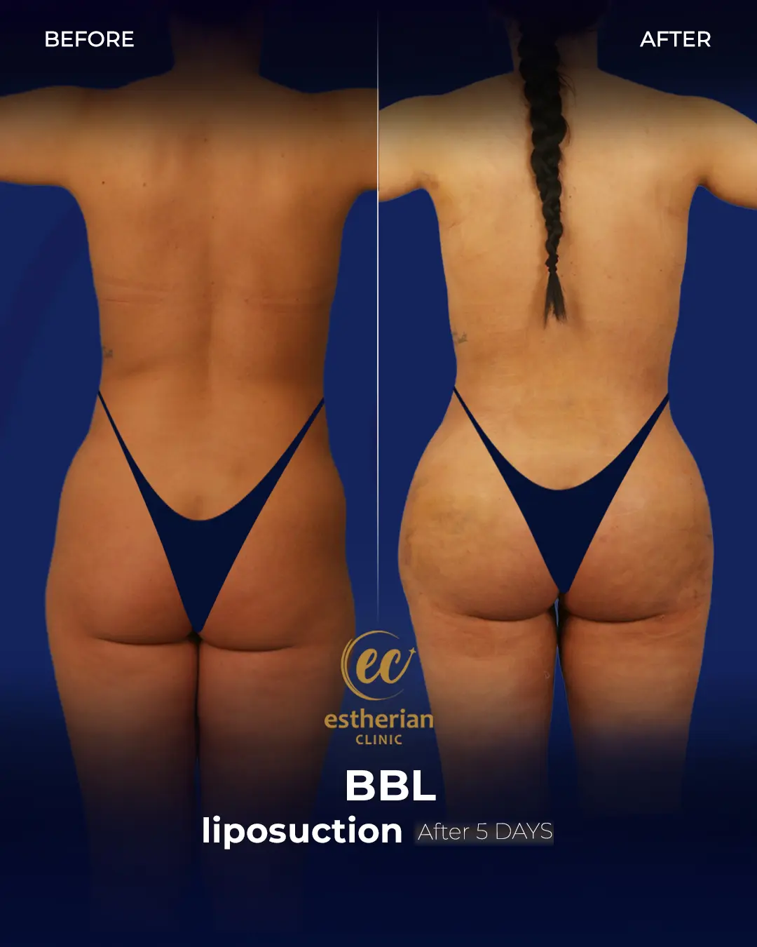 BBL - Brazilian Butt Lift Results by the Estherian Clinic