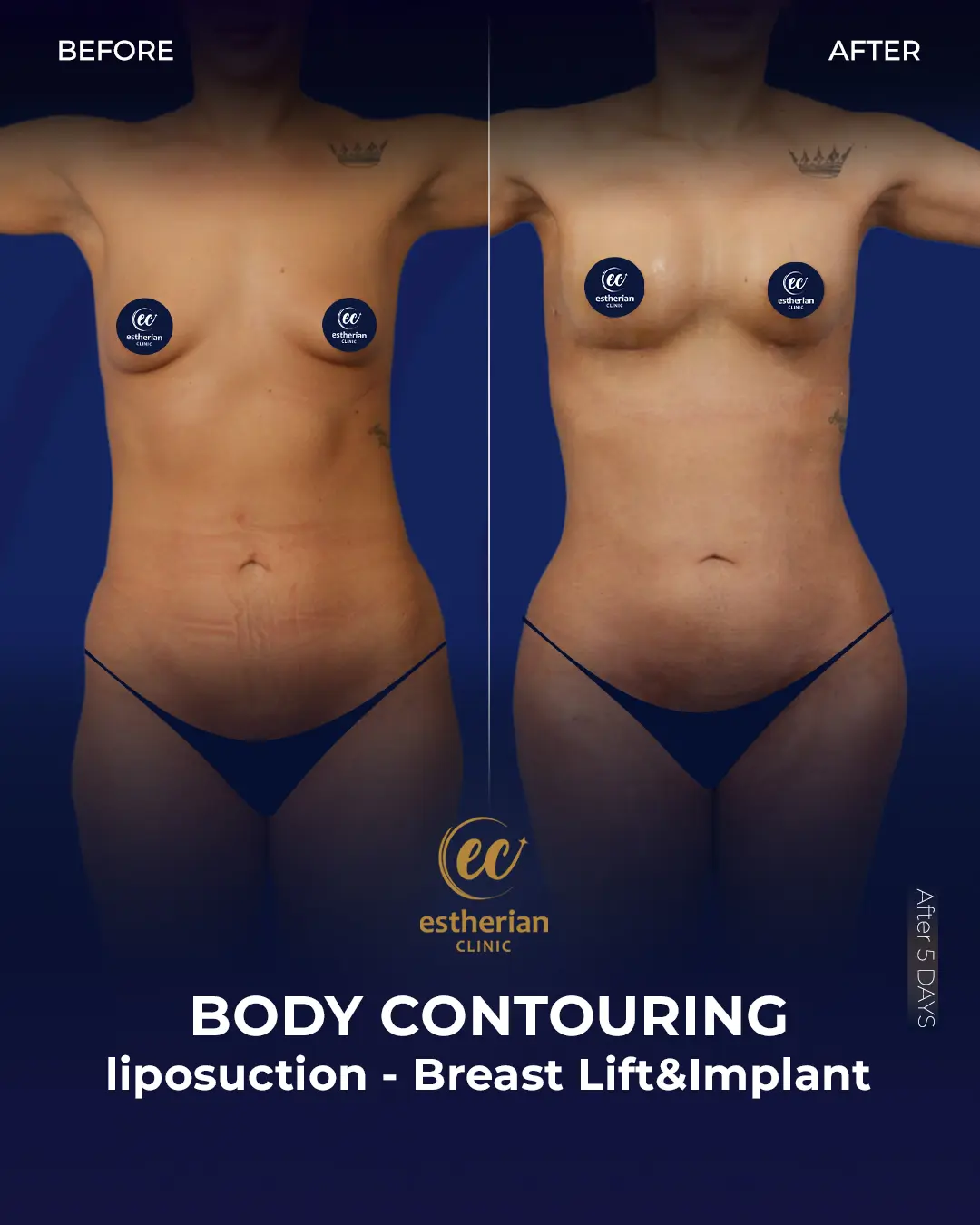 Body Contouring Surgery (before and after) by the Estherian Clinic