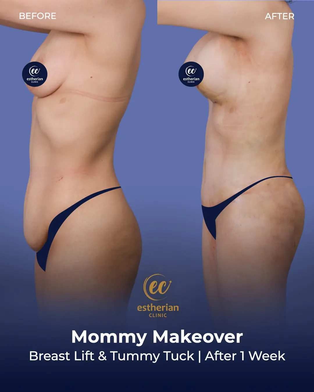 Body Contouring Surgery (before and after) by the Estherian Clinic