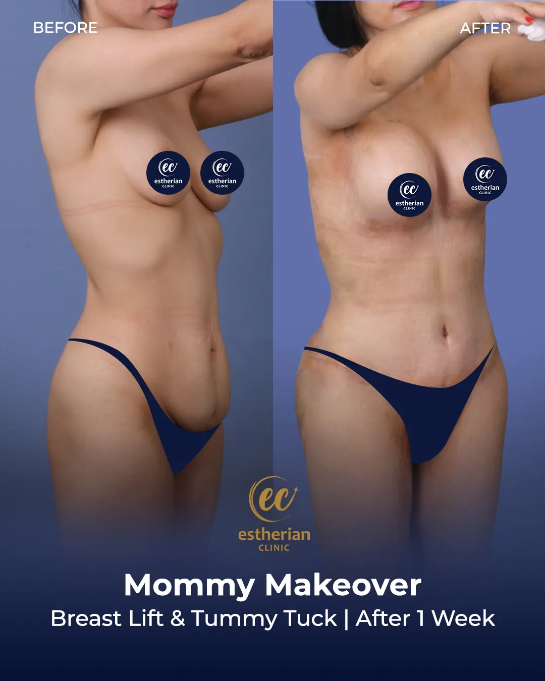 Body Contouring Surgery (before and after) by the Estherian Clinic
