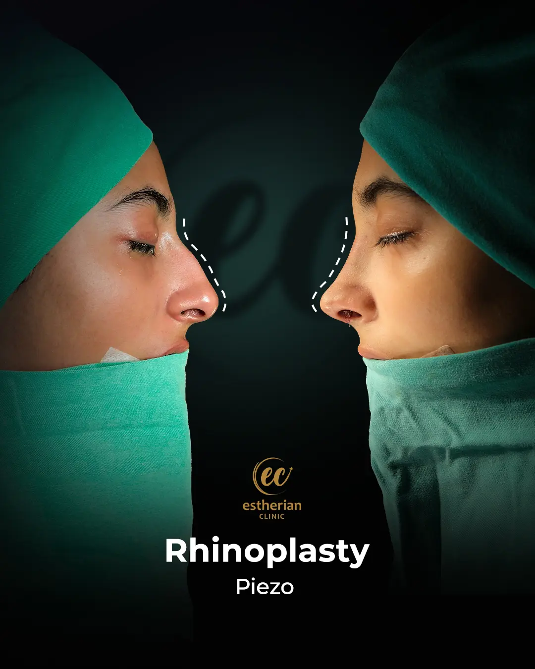 Rhinoplasty Before and After by the Estherian Clinic