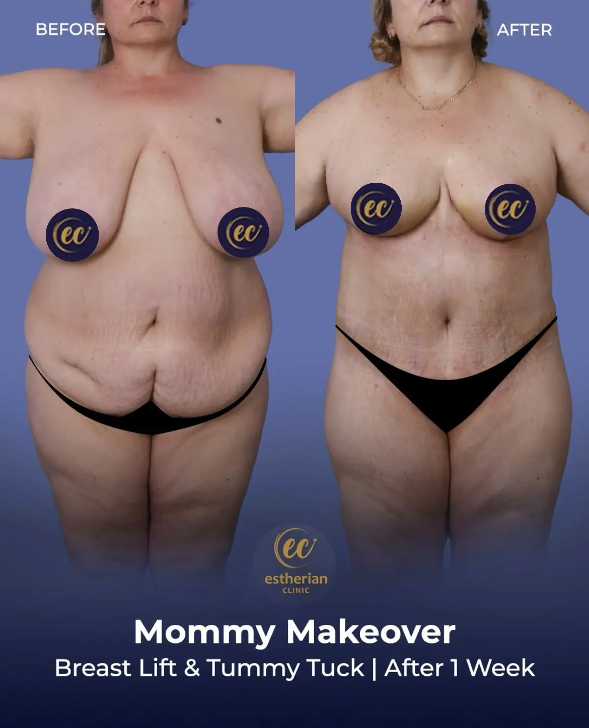 Body Contouring Surgery (before and after) by the Estherian Clinic