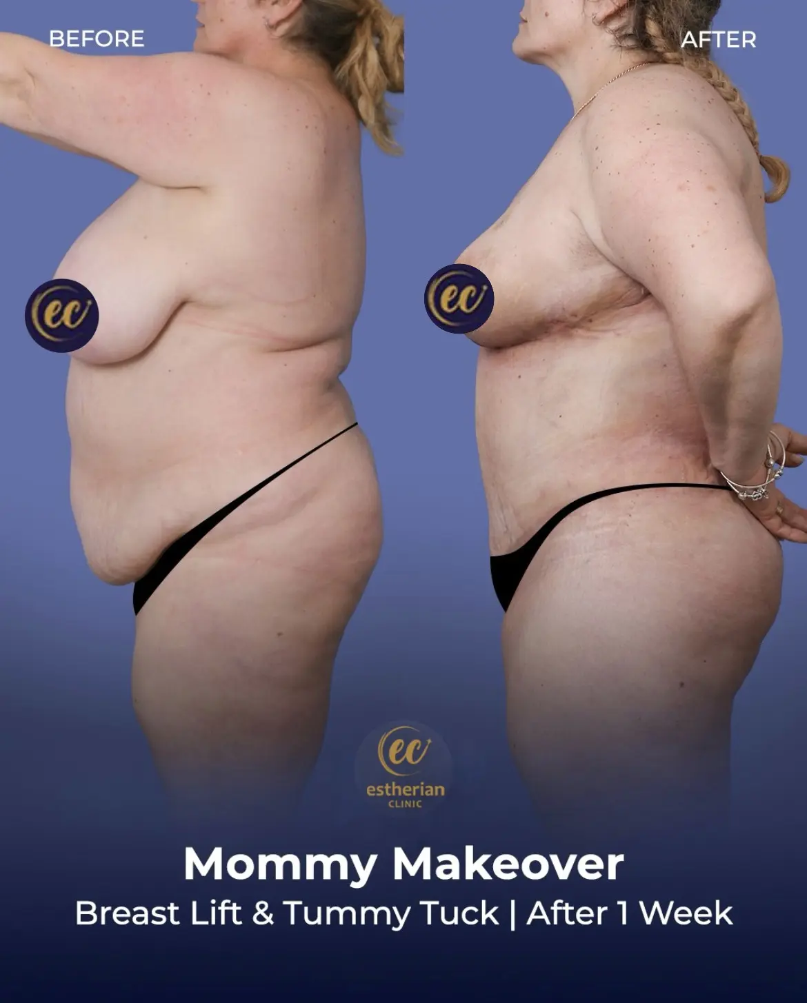 Body Contouring Surgery (before and after) by the Estherian Clinic