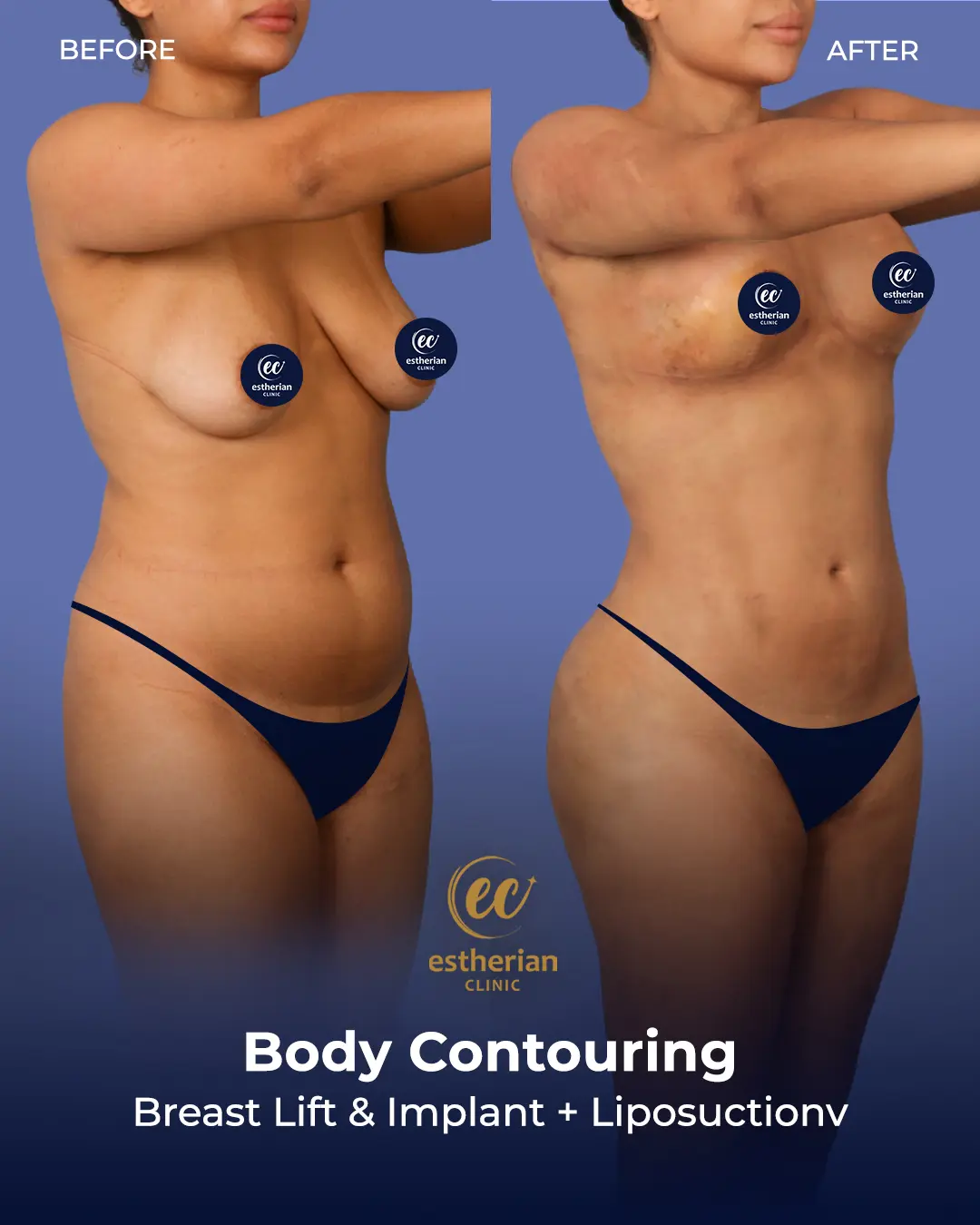 Body Contouring Surgery (before and after) by the Estherian Clinic