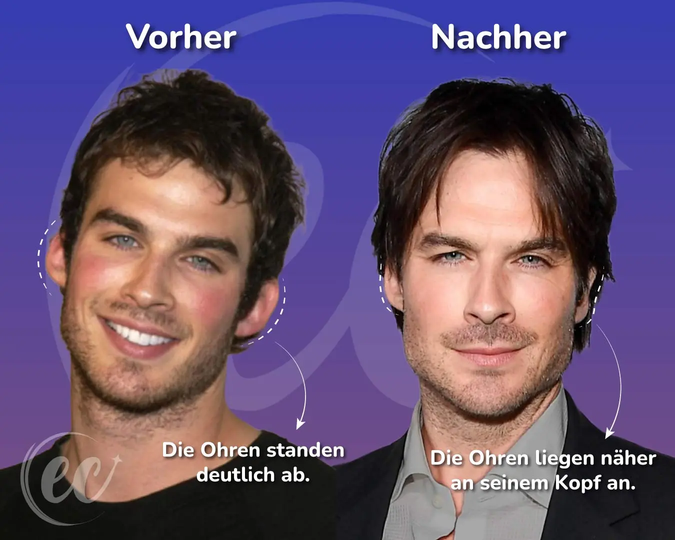 Ian Somerhalders Ohrenkorrektur