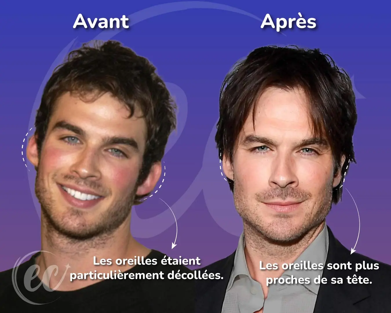 Otoplastie d'Ian Somerhalder