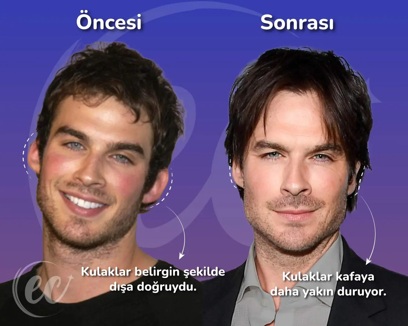 Ian Somerhalder'ın Otoplastisi