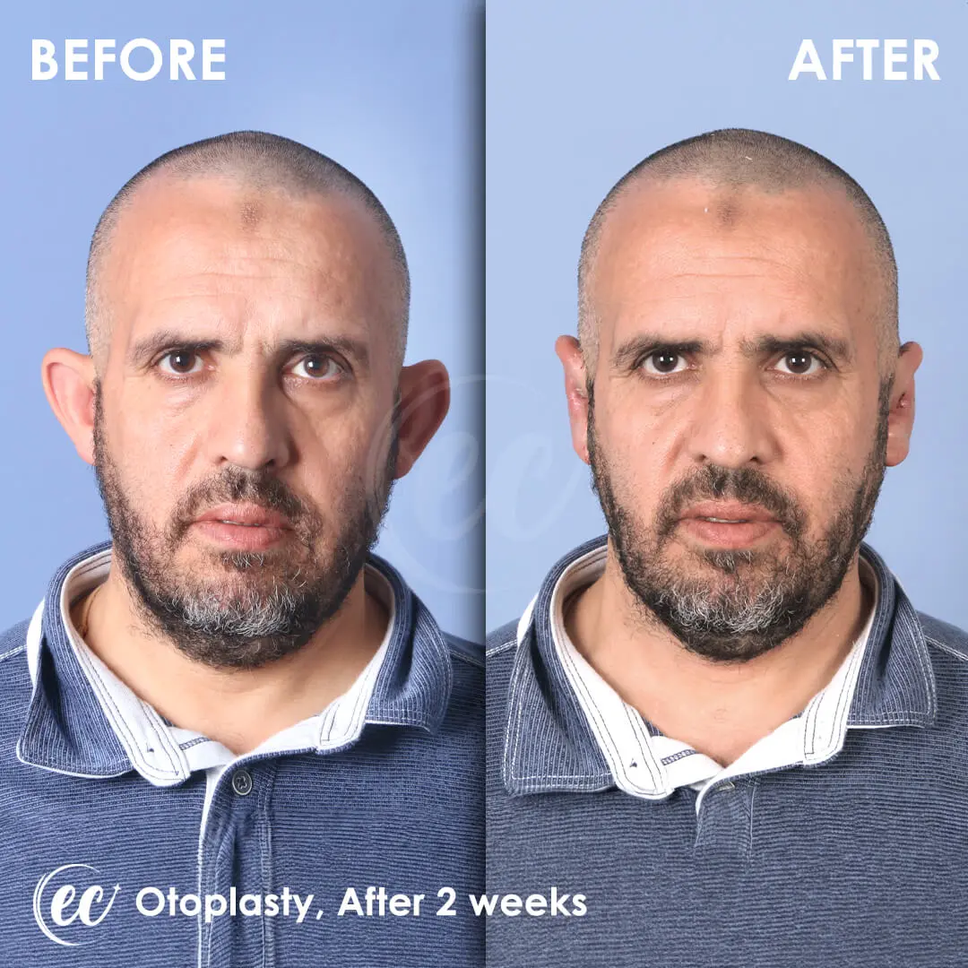 Otoplasty Results after 2 weeks by the Estherian Clinic.