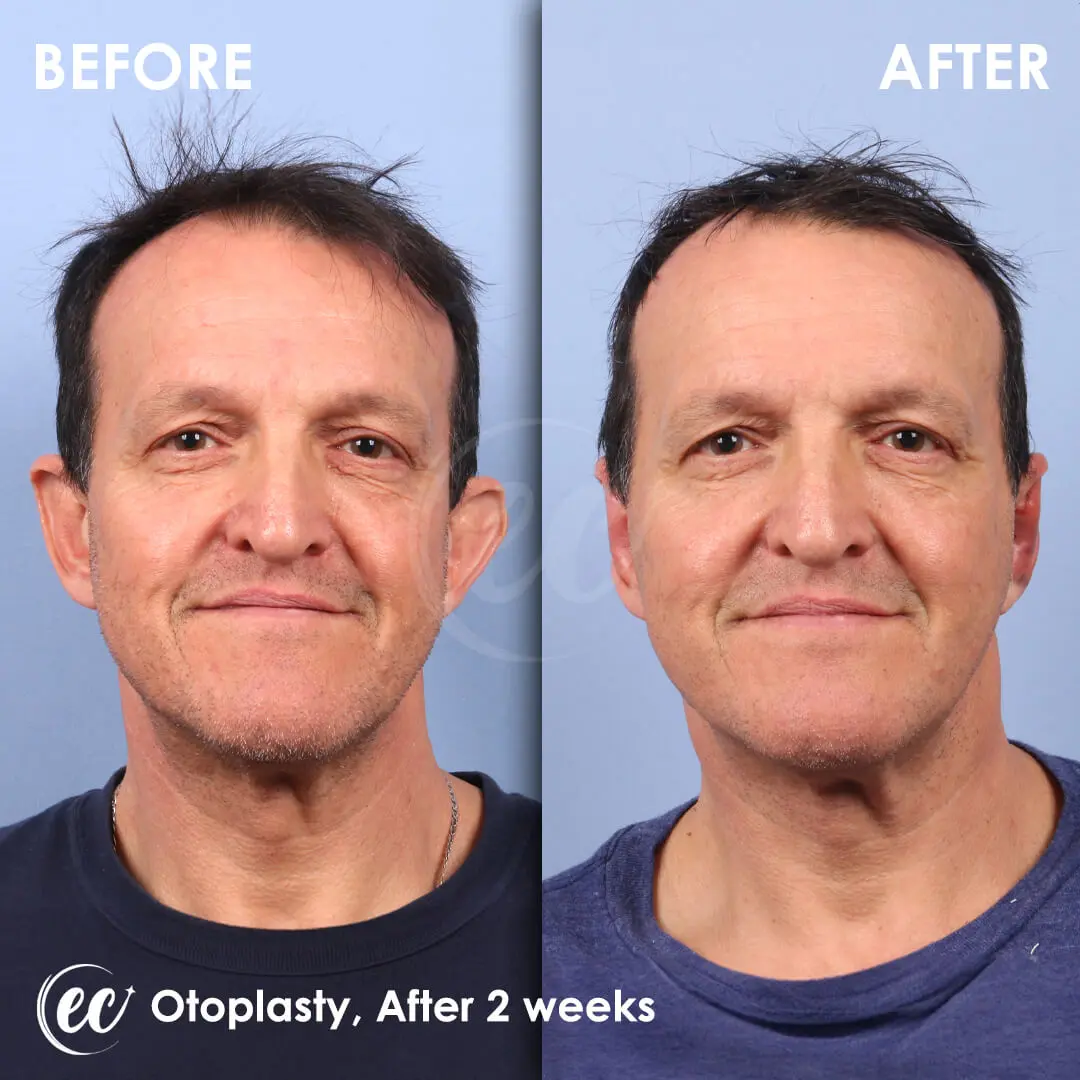 Ear Surgery before-and-after by the Estherian Clinic