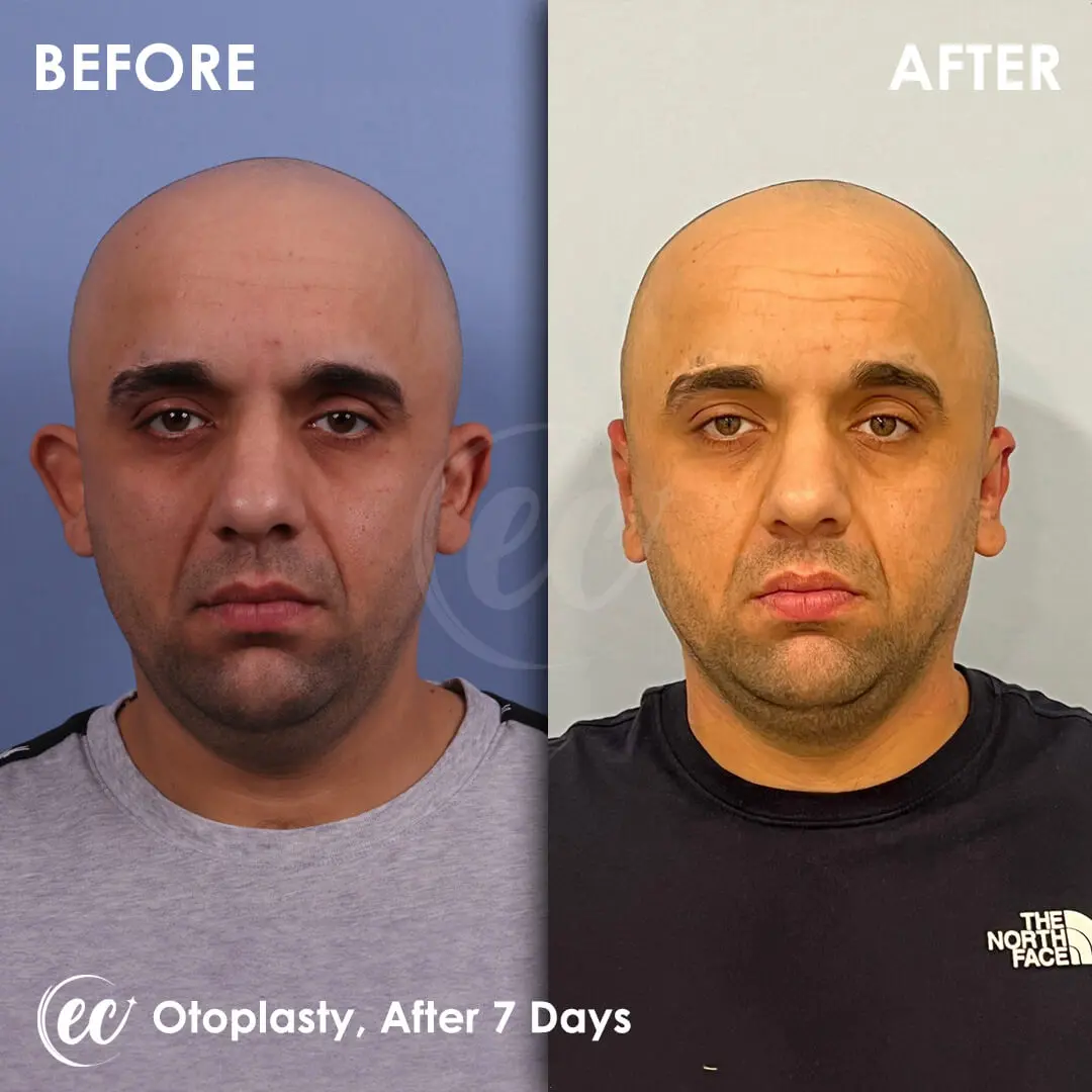 Otoplasty results 7-days Post-op