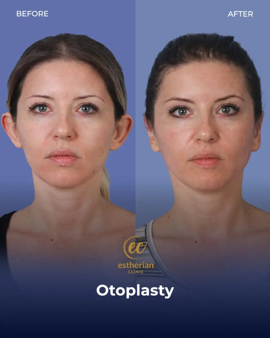 Otoplasty results (before and after) by the Estherian Clinic