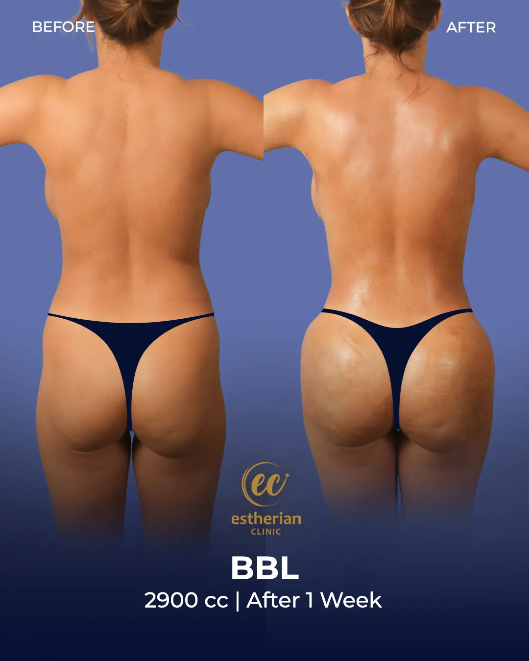 BBL - Brazilian Butt Lift Results by the Estherian Clinic