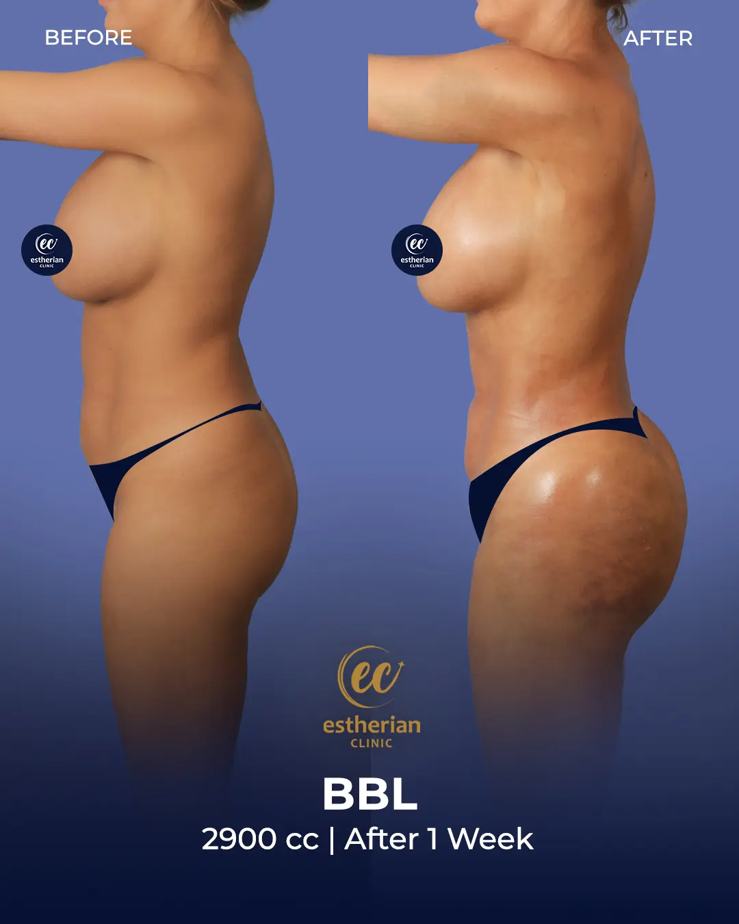 BBL - Brazilian Butt Lift Results by the Estherian Clinic