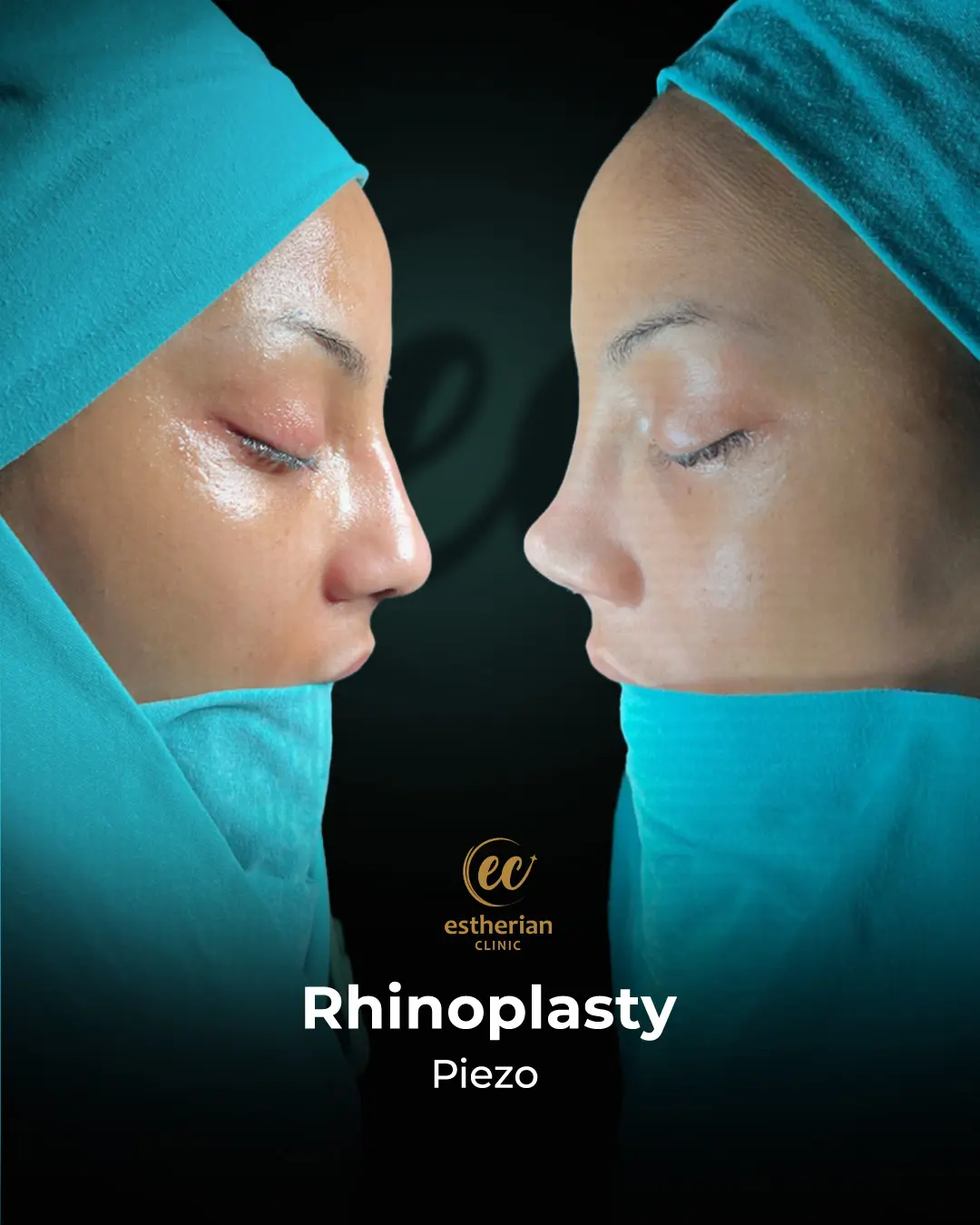 Rhinoplasty Before and After by the Estherian Clinic