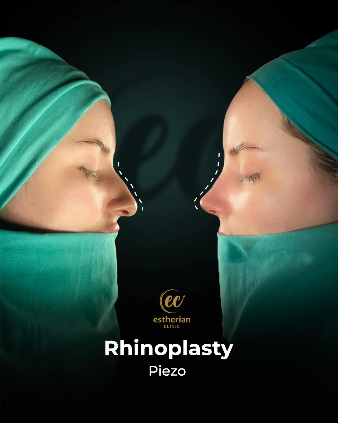 Rhinoplasty Before and After by the Estherian Clinic