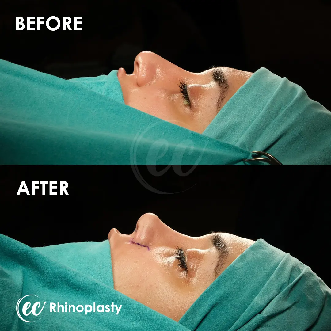 Rhinoplasty Before and After by the Estherian Clinic