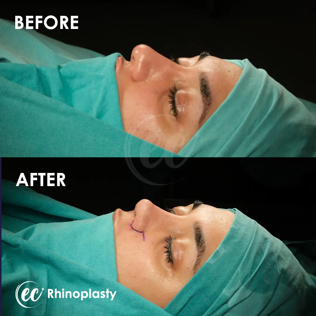 Rhinoplasty Before and After by the Estherian Clinic