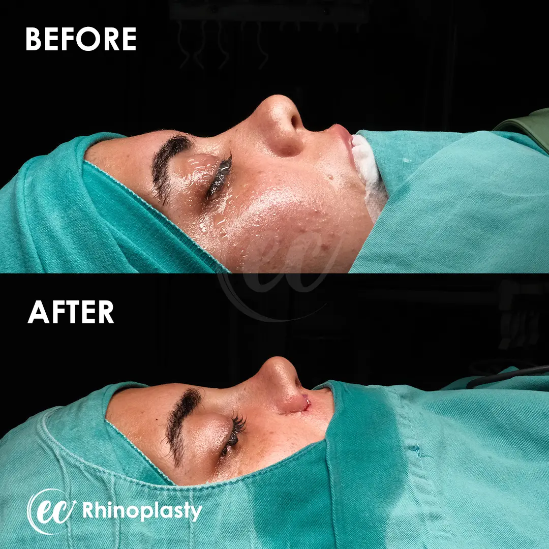 Rhinoplasty Before and After by the Estherian Clinic