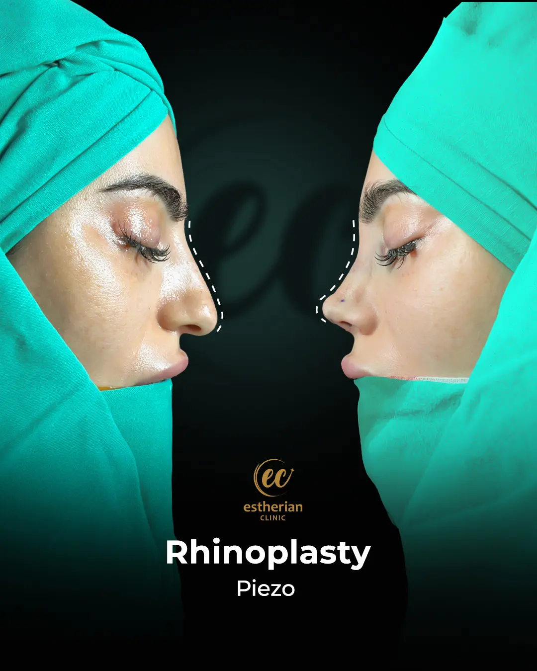 Rhinoplasty Before and After by the Estherian Clinic
