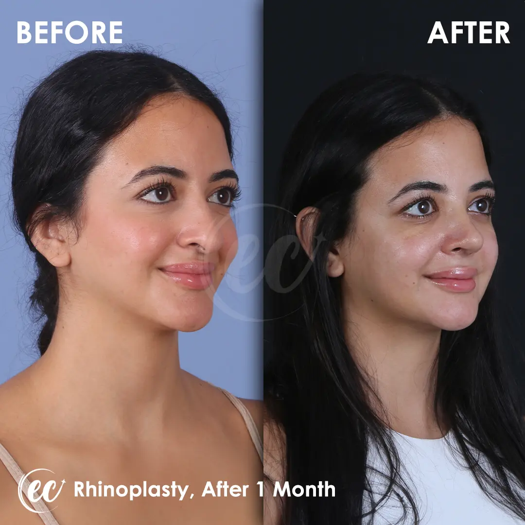 Rhinoplasty Before and After by the Estherian Clinic