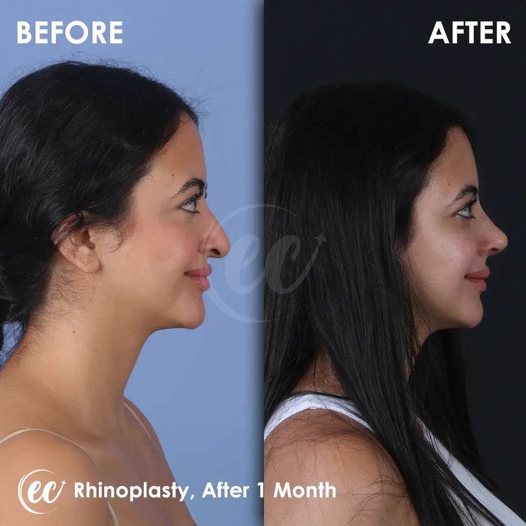 Rhinoplasty Before and After by the Estherian Clinic