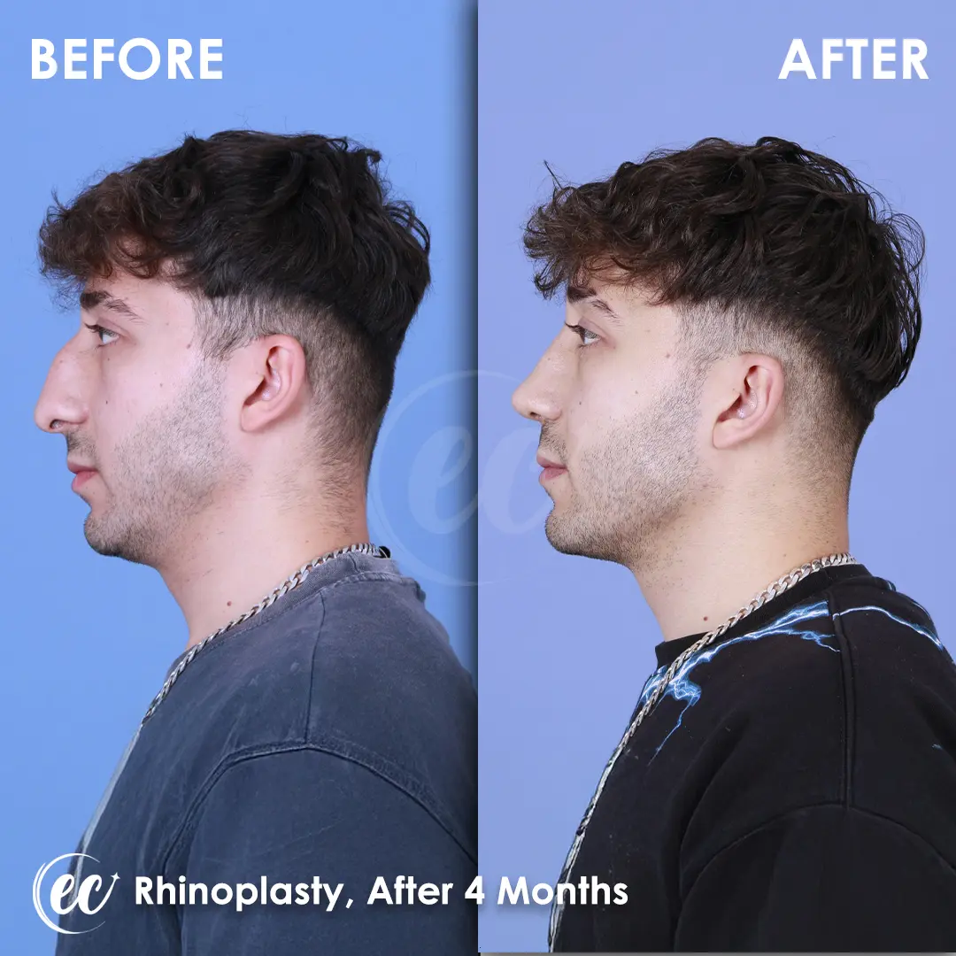 Rhinoplasty Before and After by the Estherian Clinic