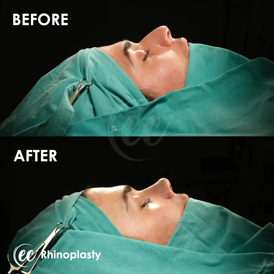Rhinoplasty Before and After by the Estherian Clinic