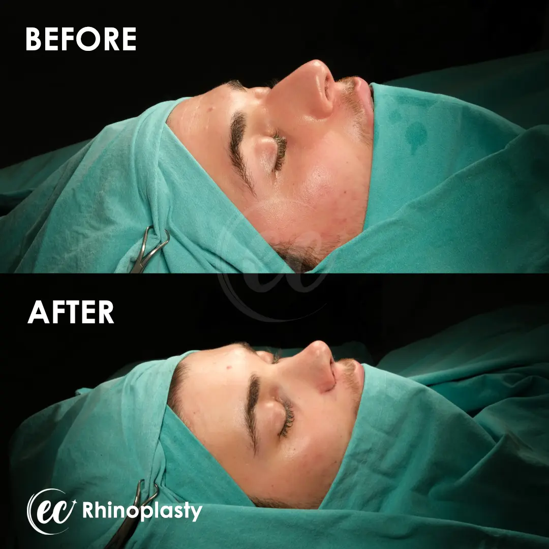 Rhinoplasty Before and After by the Estherian Clinic