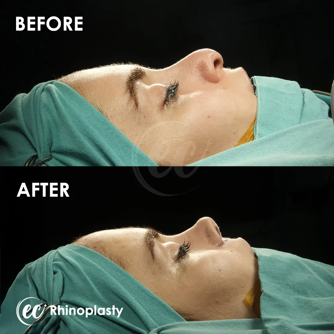 Rhinoplasty Before and After by the Estherian Clinic