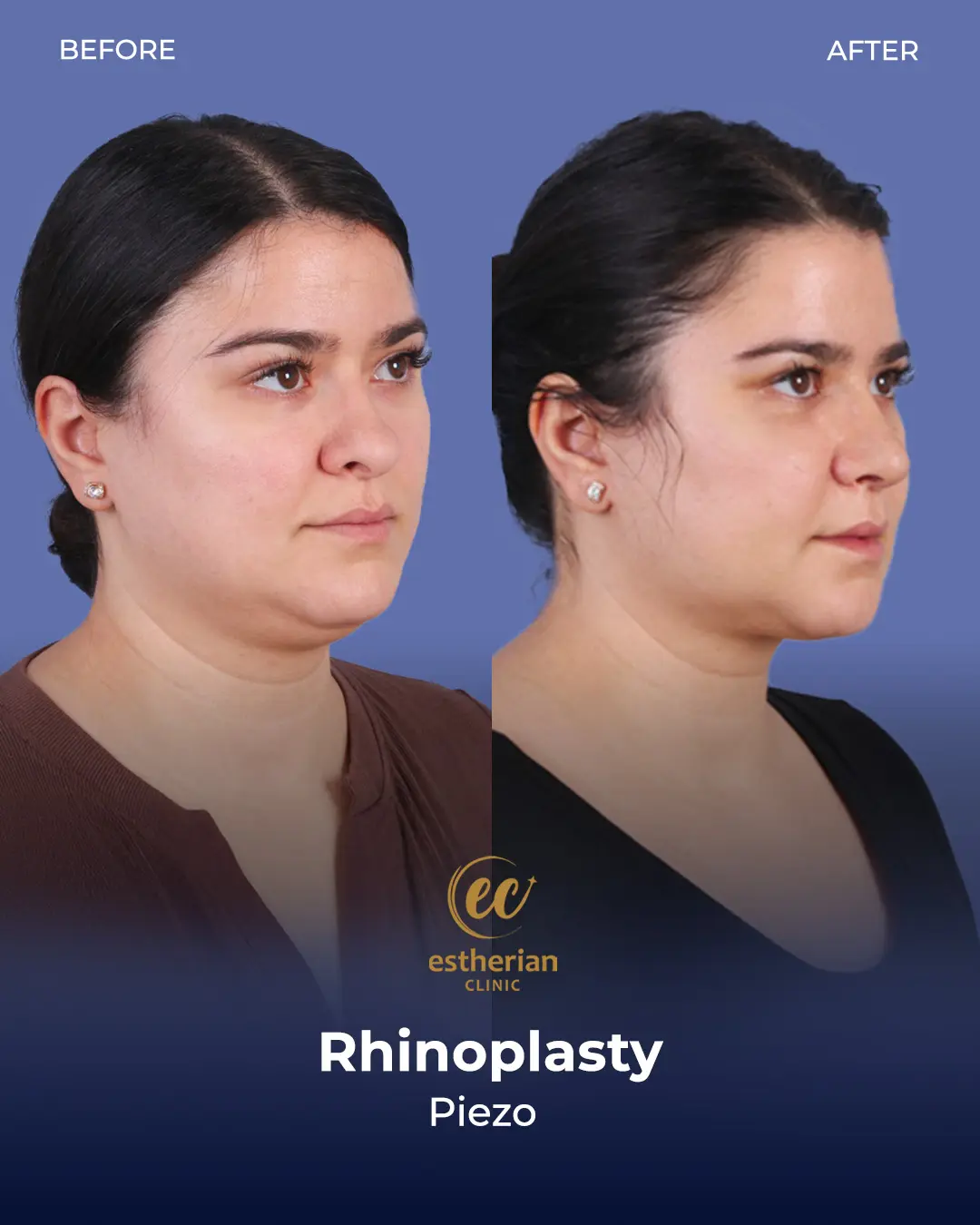 Rhinoplasty Before and After by the Estherian Clinic