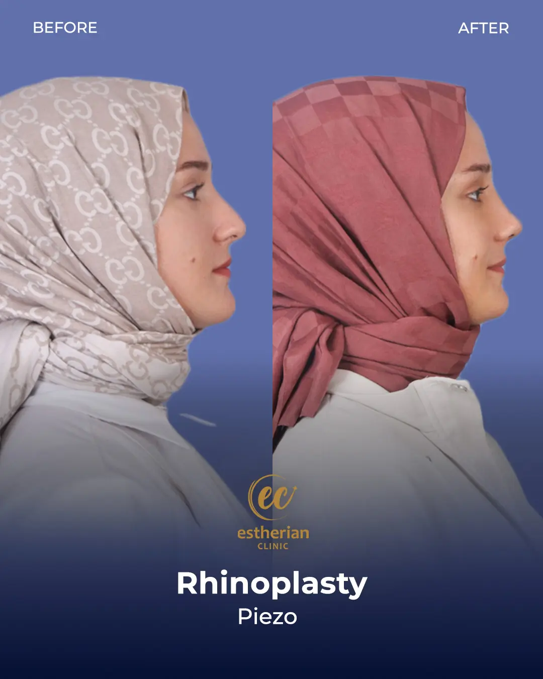 Rhinoplasty Before and After by the Estherian Clinic