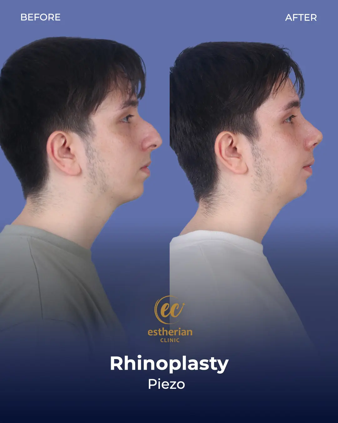 Rhinoplasty Before and After by the Estherian Clinic