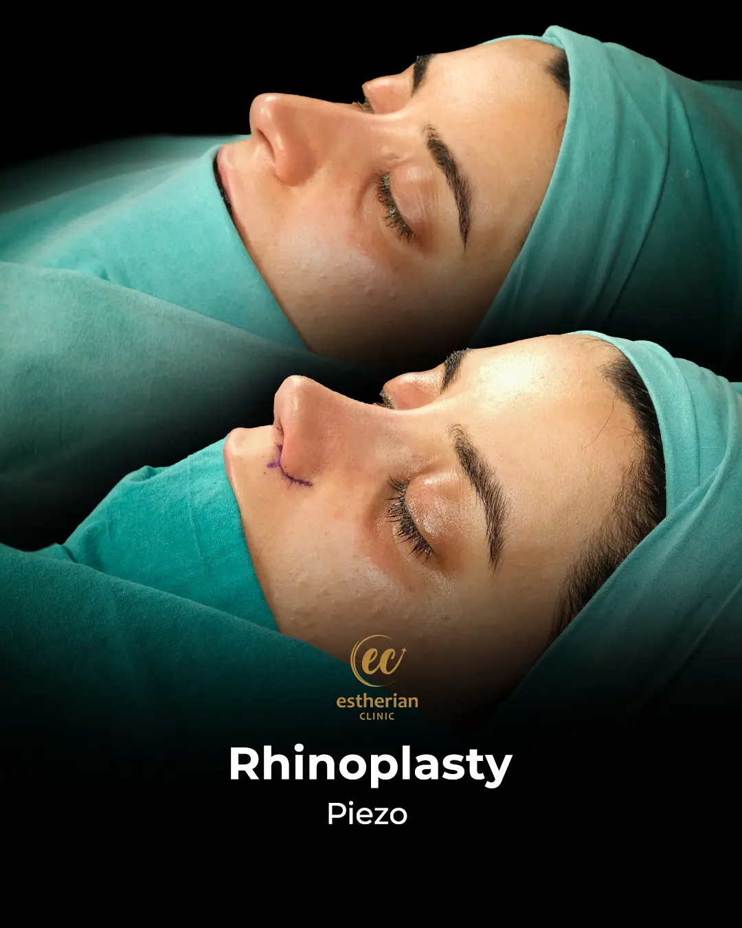 Rhinoplasty Before and After by the Estherian Clinic