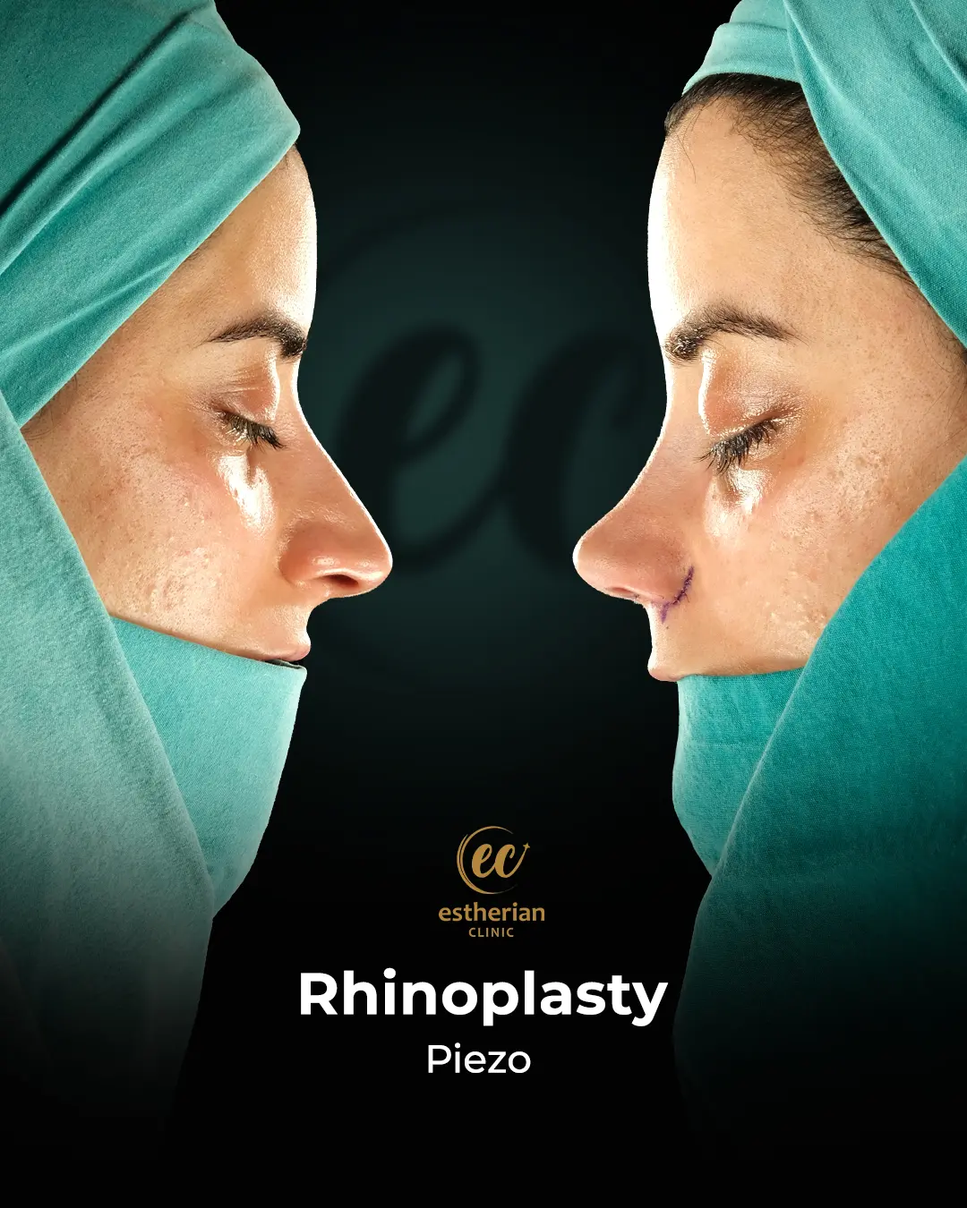 Rhinoplasty Before and After by the Estherian Clinic