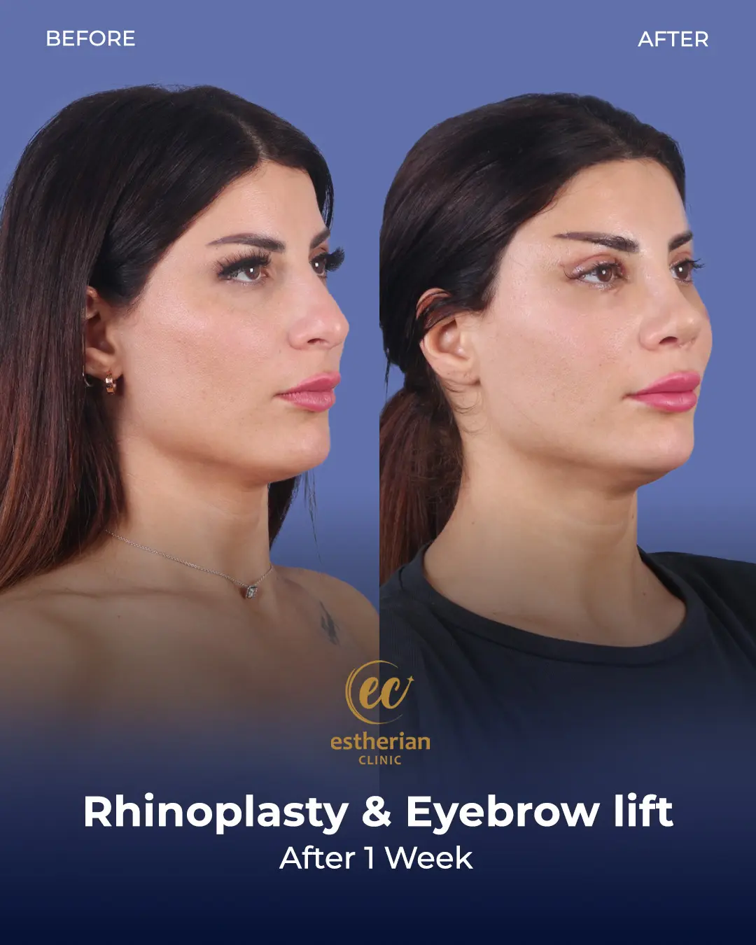 Rhinoplasty Before and After by the Estherian Clinic