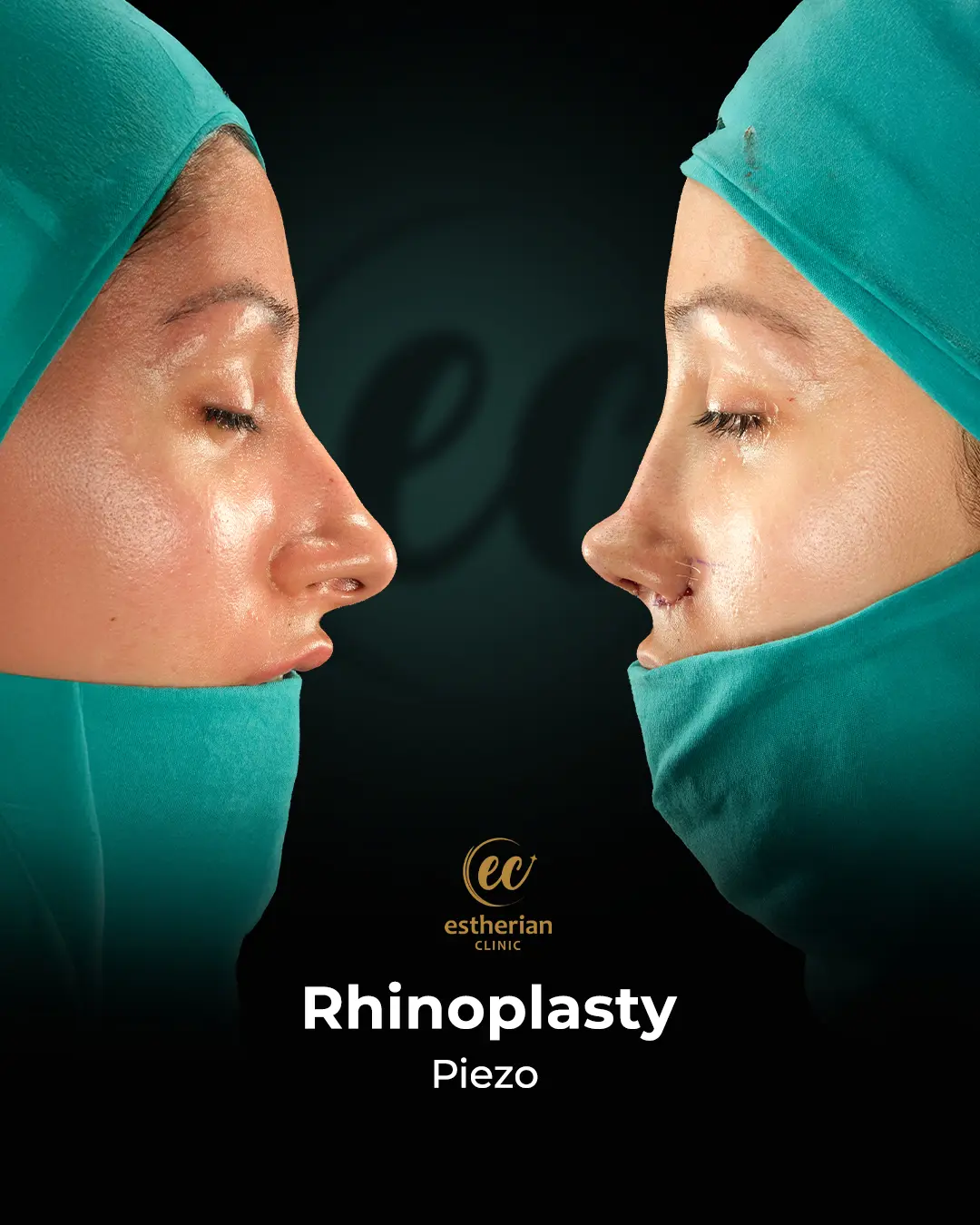 Rhinoplasty Before and After by the Estherian Clinic