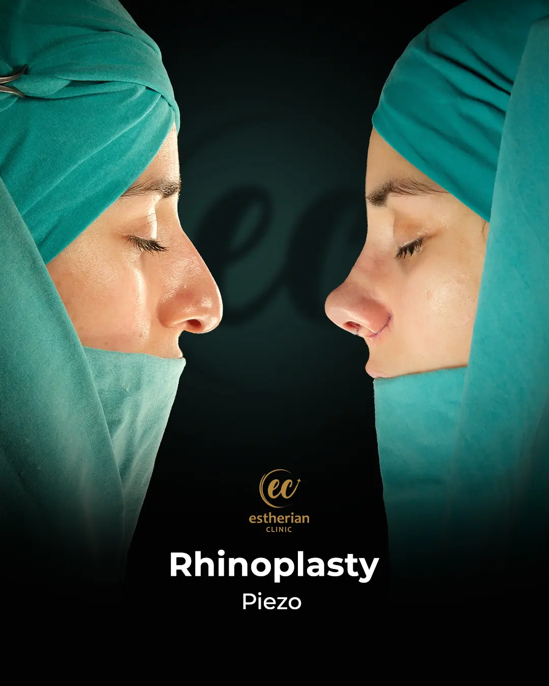 Rhinoplasty Before and After by the Estherian Clinic
