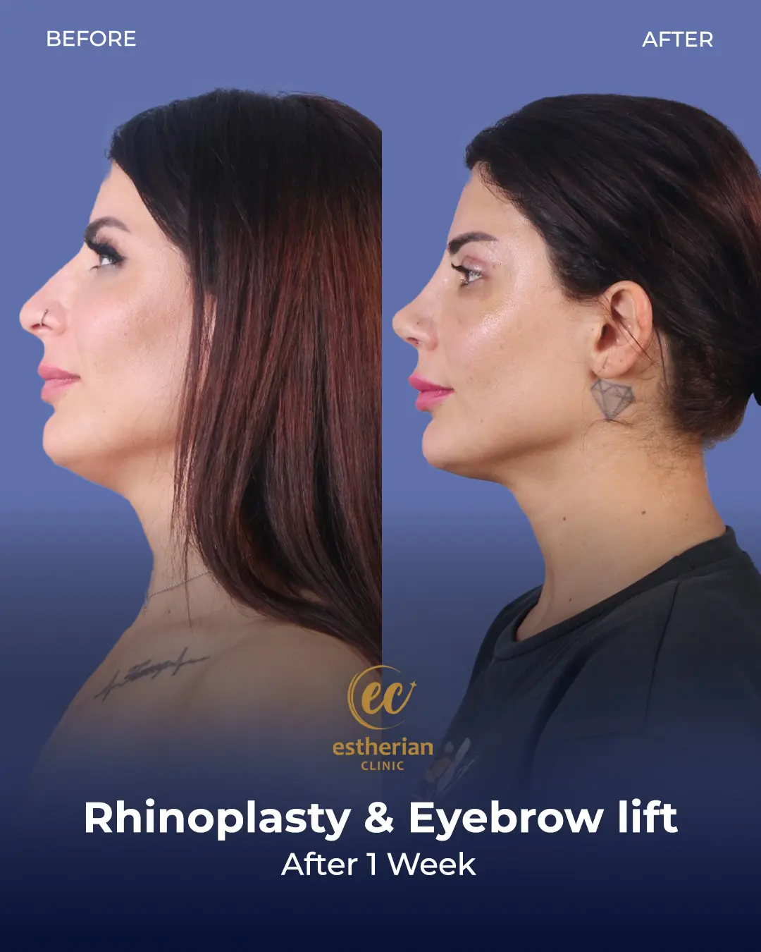 Rhinoplasty Before and After by the Estherian Clinic