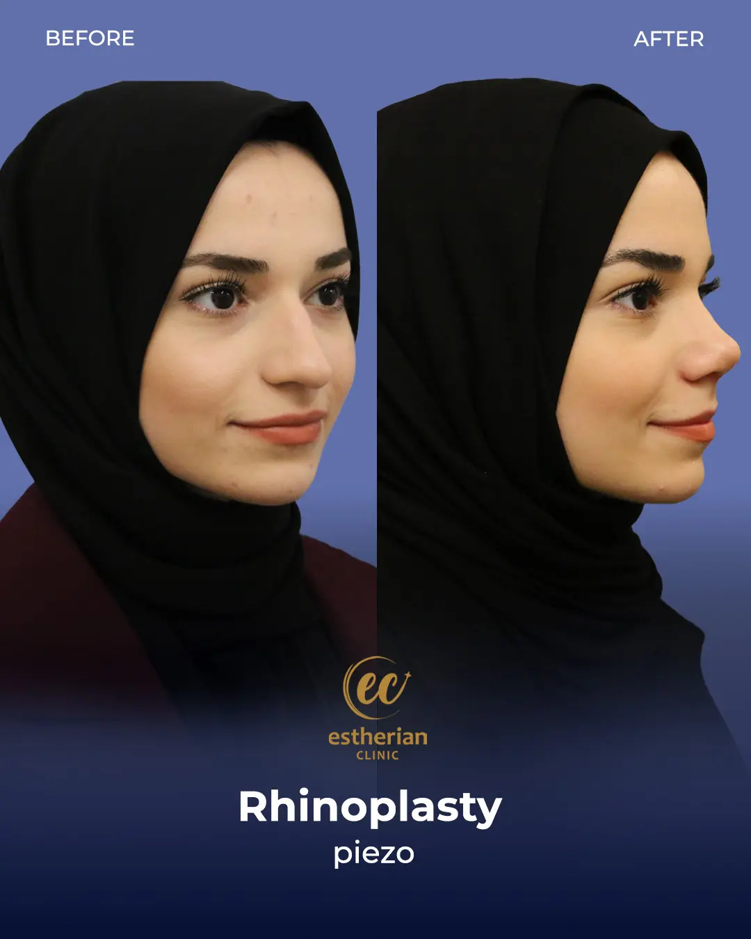 Rhinoplasty Before and After by the Estherian Clinic