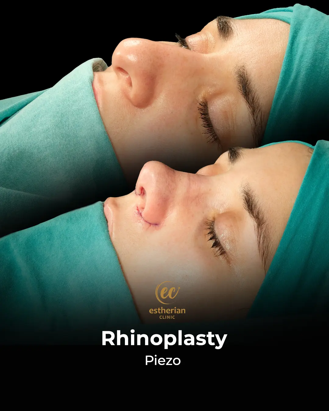Rhinoplasty Before and After by the Estherian Clinic