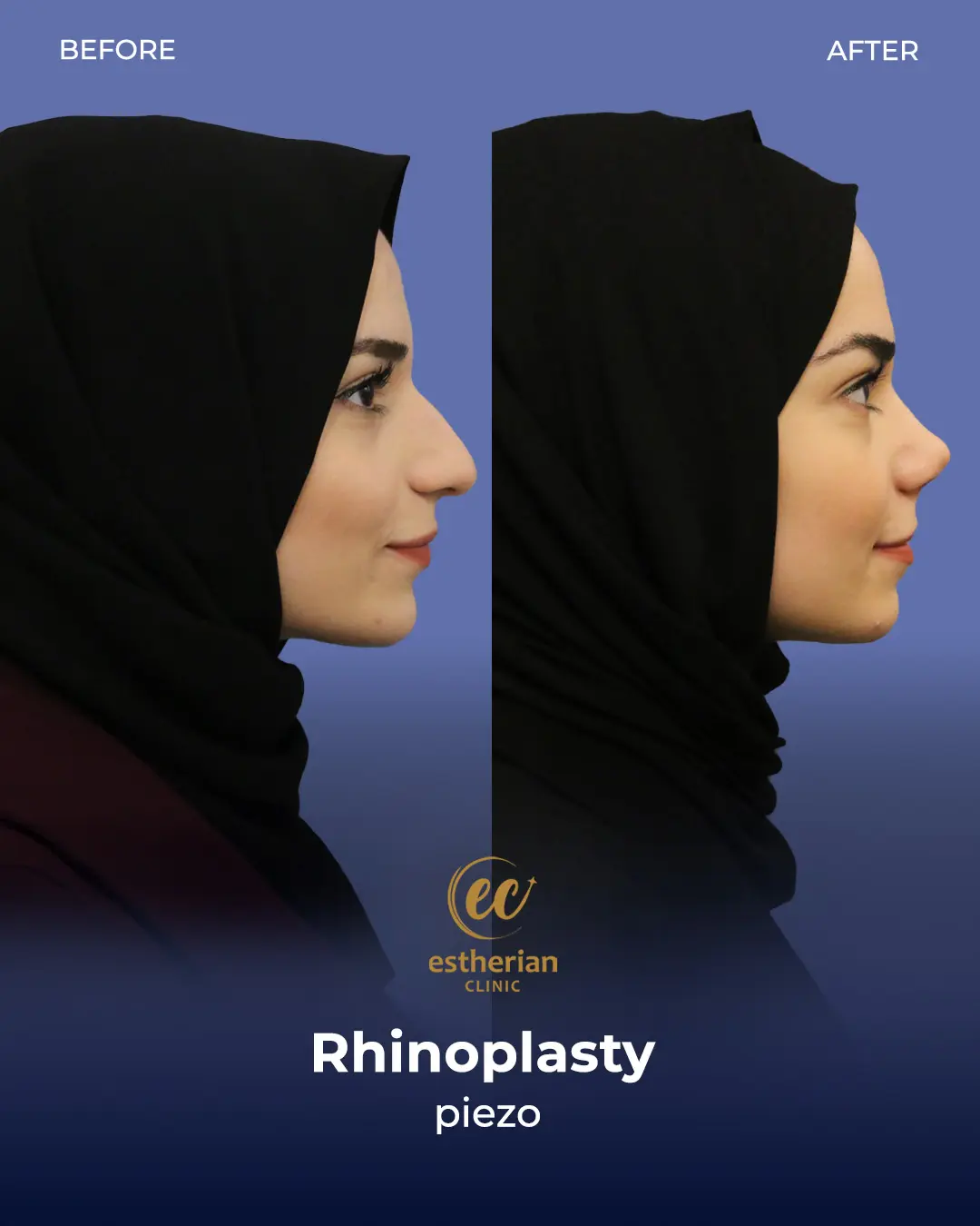 Rhinoplasty Before and After by the Estherian Clinic