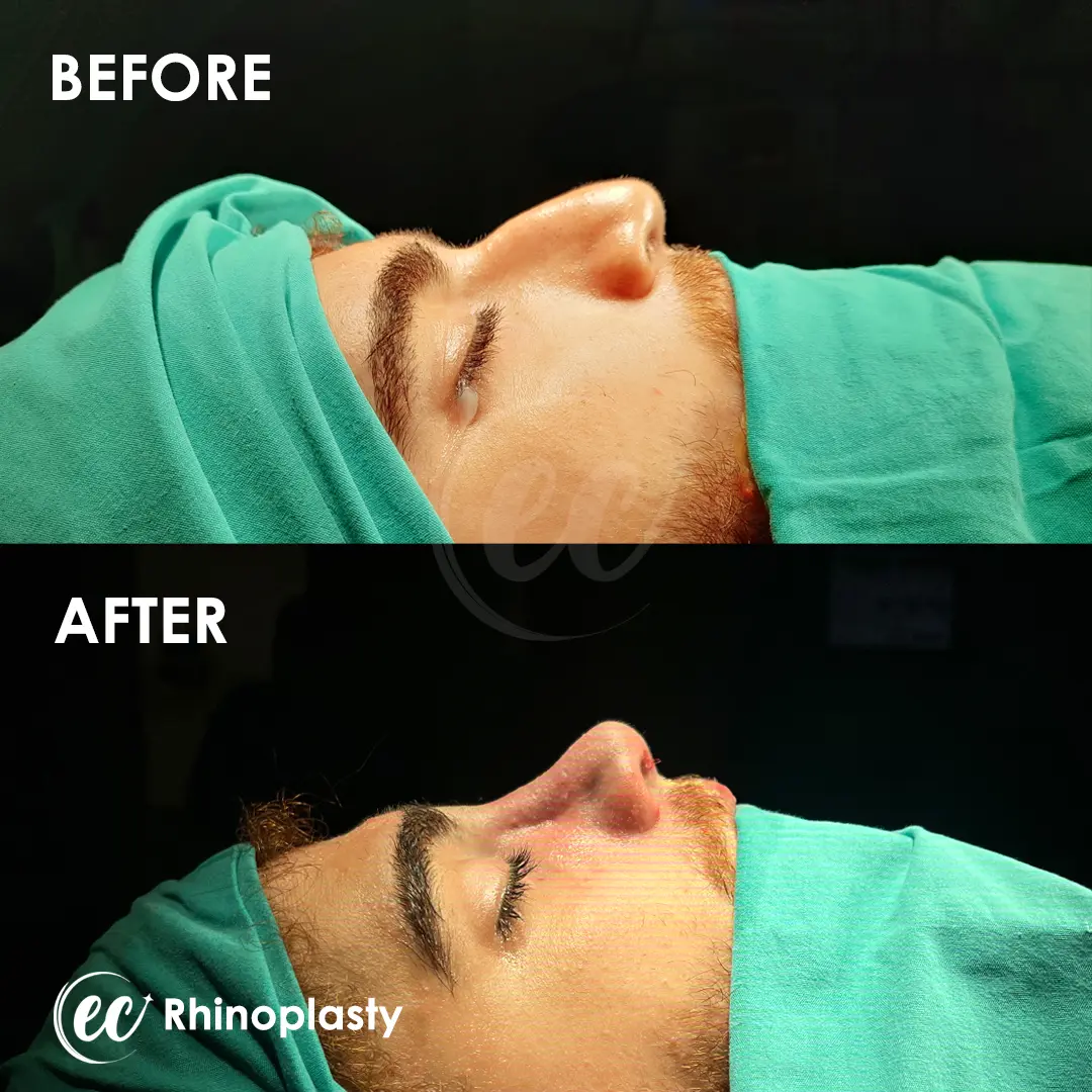 Rhinoplasty Before and After by the Estherian Clinic