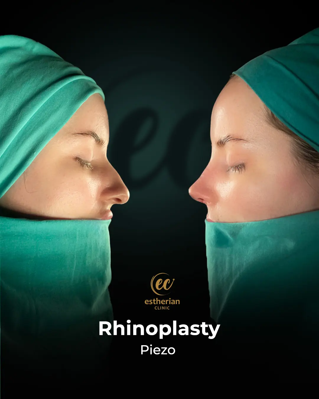 Rhinoplasty Before and After by the Estherian Clinic