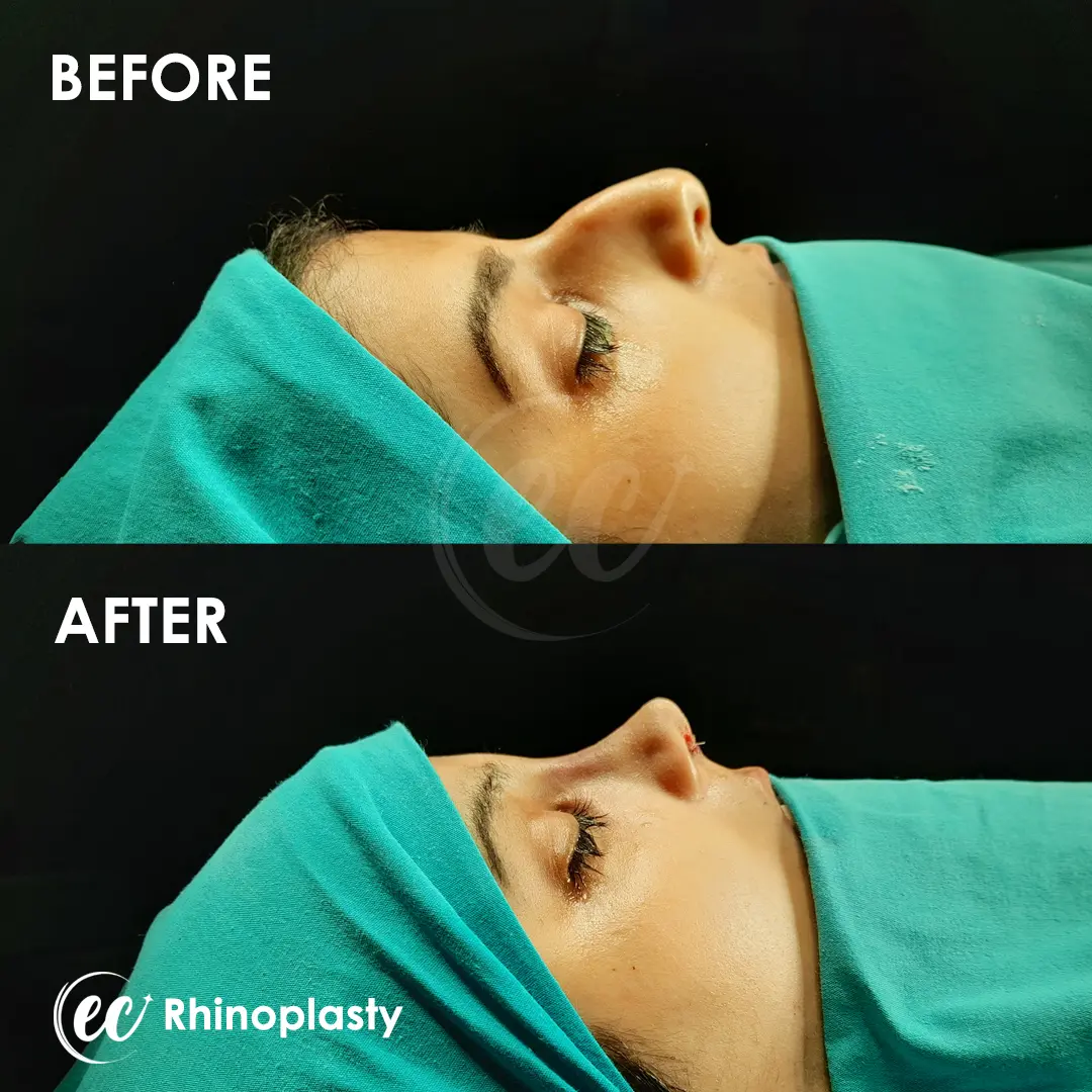 Rhinoplasty Before and After by the Estherian Clinic