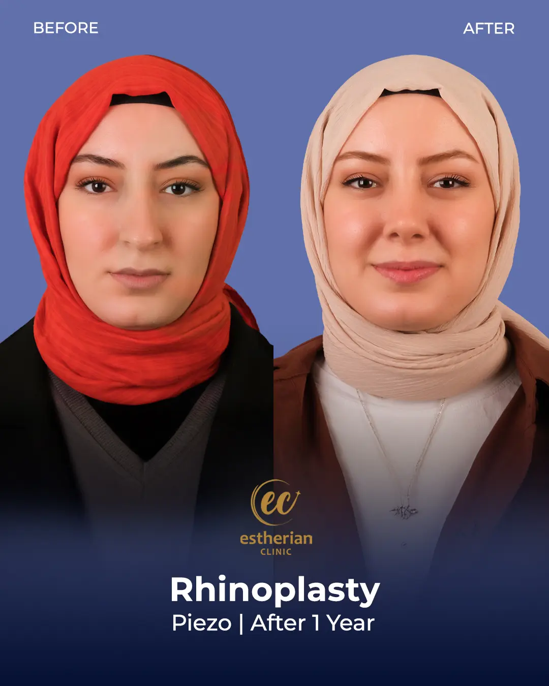 Rhinoplasty Before and After by the Estherian Clinic
