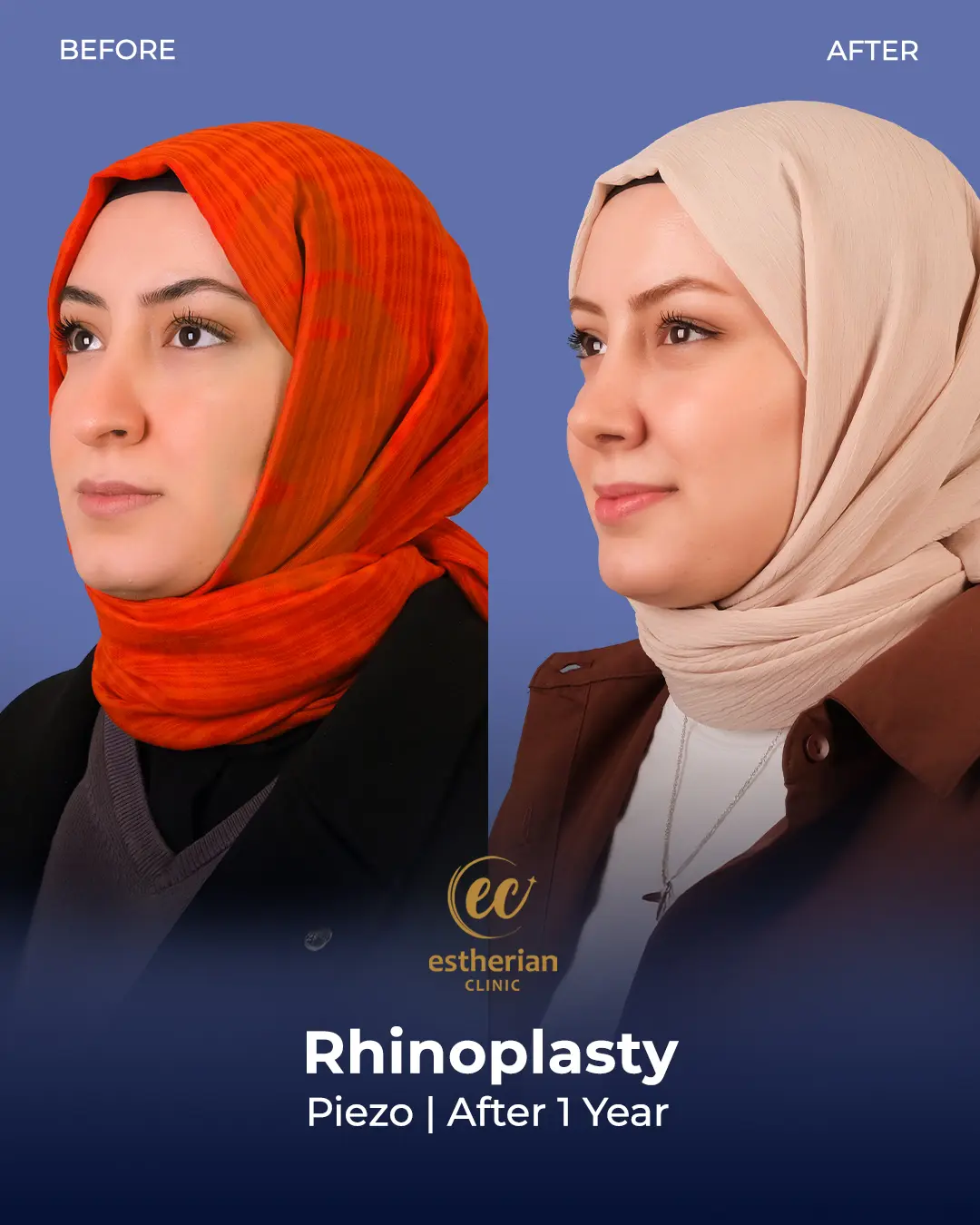 Rhinoplasty Before and After by the Estherian Clinic