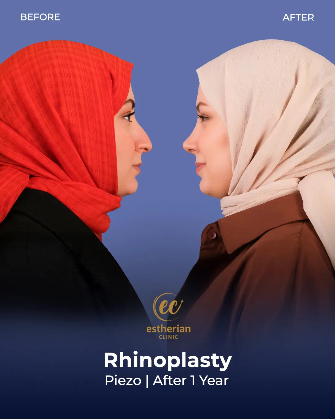 Rhinoplasty Before and After by the Estherian Clinic
