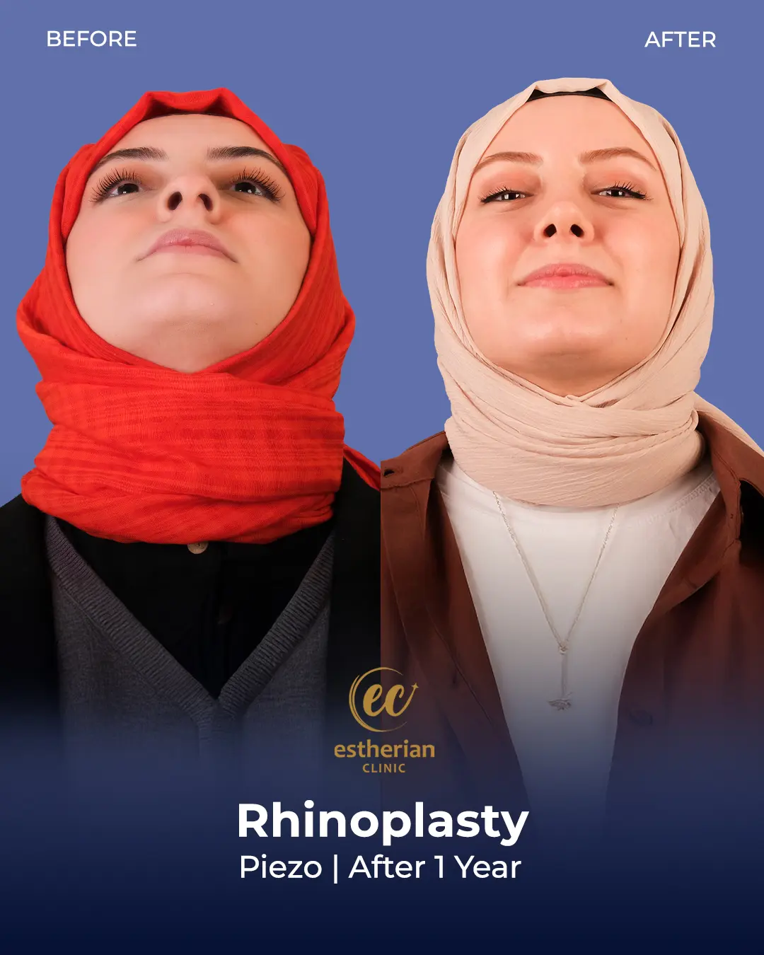 Rhinoplasty Before and After by the Estherian Clinic