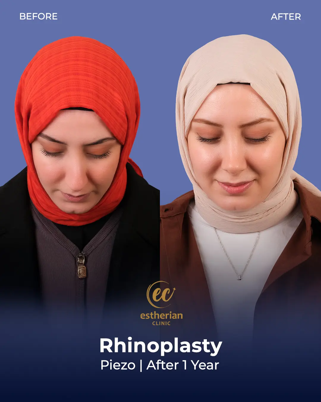 Rhinoplasty Before and After by the Estherian Clinic
